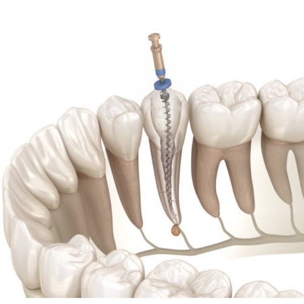 Muela con tratamiento de endodoncia en proceso, con instrumentos y materiales especializados para odontología personalizada.