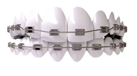 Puentes dentales personalizados con ortodoncia estética en porcelana y zafiro, diseñados para restaurar la funcionalidad y estética dental con precisión.