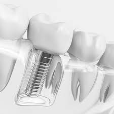 Implantes dentales personalizados de alta precisión para restaurar sonrisas naturales y funcionales en odontología moderna.