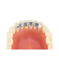 Nunca olvidar la importancia de los productos odontológicos personalizados en el cuidado dental. La imagen muestra una prótesis dental personalizada para una adecuada restauración bucal.